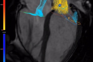 4D flow MRI scans could revolutionise blood flow assessment in the heart