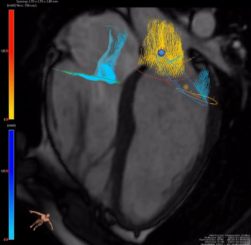 4D flow MRI scans could revolutionise blood flow assessment in the heart
