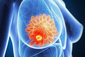 AI-powered blood test first to spot earliest sign of breast cancer