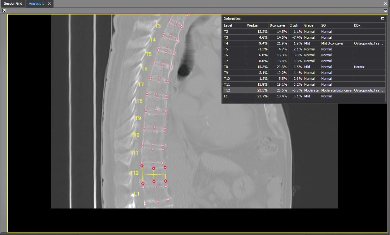 AI service detects vertebral fractures in more than 2,000 NHS patients 