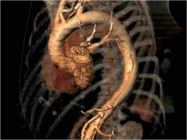 aortic dissection pre surgery COMMENT: Vascular surgeon, Matt Thompson, on the importance of research and development in aortic dissection