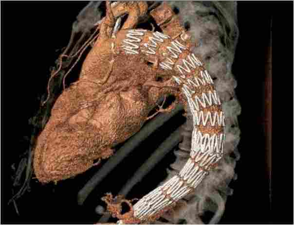 aortic dissection post surgery COMMENT: Vascular surgeon, Matt Thompson, on the importance of research and development in aortic dissection