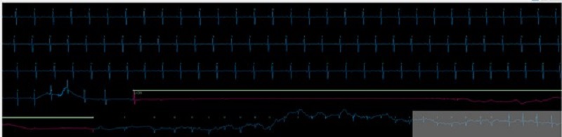 The green line here shows the Zio XT’s AI algorithm detecting the 28 second period where the patient’s heart stopped beating