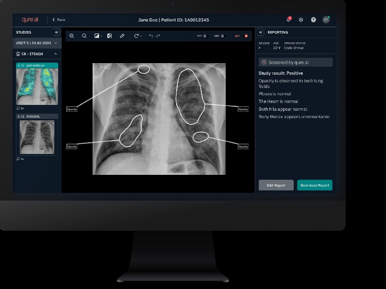 InHealth will be deploying Qure.ai's AI solution to aid in the classification of chest X-rays into normal and abnormal exam