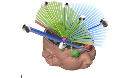 HybridArc2 Latest advancement in radiosurgery marks opportunity to expand the use of SRS to various tumour types