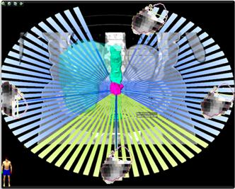 HybridArc3 Latest advancement in radiosurgery marks opportunity to expand the use of SRS to various tumour types
