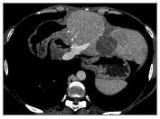 A CT scan performed six weeks after treatment showed a 50% reduction in tumour size