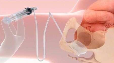 The Fetal Pillow from Safe Obstetric Systems won the Award for Best Medical Device title