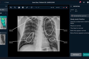Can AI spot lung cancer and cut diagnosis times?