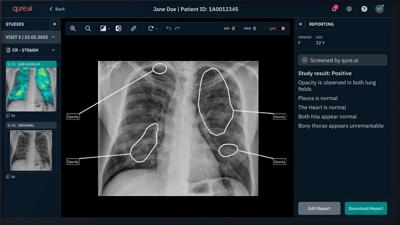 Can AI spot lung cancer and cut diagnosis times?