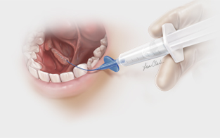 Cook Medical launches SialoCath salivary duct catheter