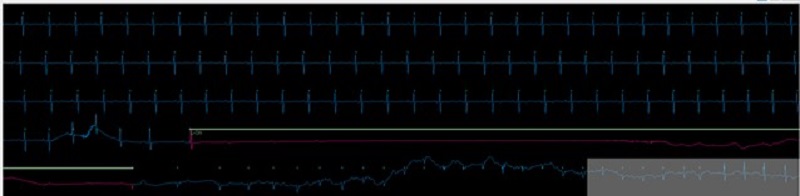 Dramatic cut in waiting times for hospitals trialling AI heart monitoring technology