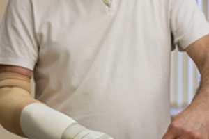 First UK patient fitted with futuristic Michelangelo hand