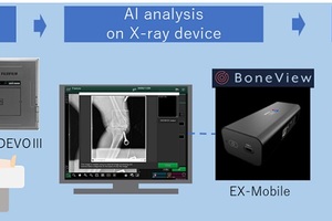 Fujifilm uses AI software to identify bone trauma