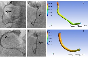 Heart disease computer will \'revolutionise\' cardiac treatment