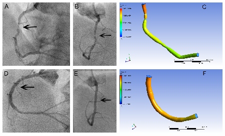 Heart disease computer will \'revolutionise\' cardiac treatment