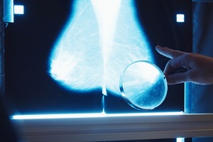 Leeds trust to trial AI software for breast cancer screening
