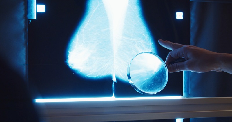 Leeds trust to trial AI software for breast cancer screening