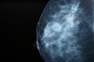 Mammography services transformed across Northern Ireland with innovative digital technology