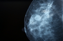 Mammography services transformed across Northern Ireland with innovative digital technology