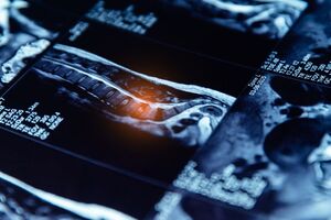 New bone scanners to be installed across South West in £2.6m early-diagnosis drive
