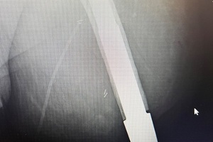 NHS funds first osseointegration surgery at St George Hospital