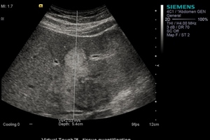 NICE plans to support device for diagnosing liver damage without surgery
