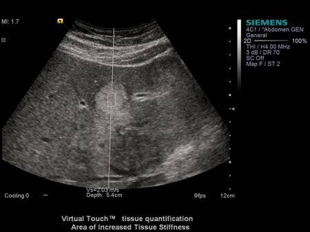 NICE plans to support device for diagnosing liver damage without surgery