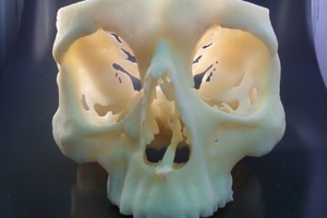 Reduced surgery times and lower costs follow implementation of 3D printing solutions at 12 NHS hospitals