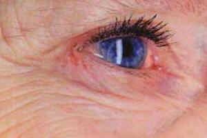 Sheffield hospital first to offer innovative new treatment for wet AMD