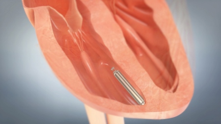St Jude Medical unveils world\'s-first leadless pacemaker