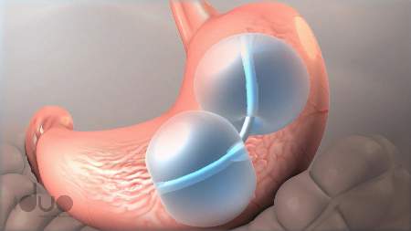 UK patient slims down thanks to revolutionary new weight loss device